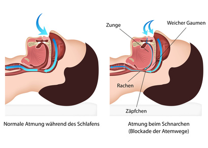 Schnarchen Gesundheitgvat